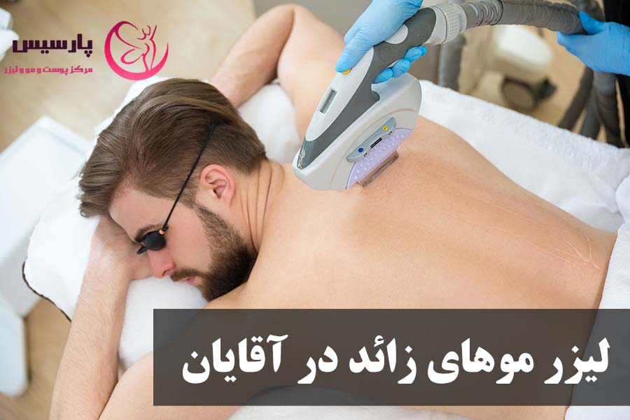 لیزر موهای زائد در آقایان