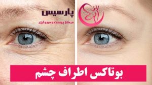 بوتاکس اطراف چشم