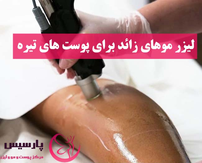 لیزر موهای زائد برای پوست های تیره