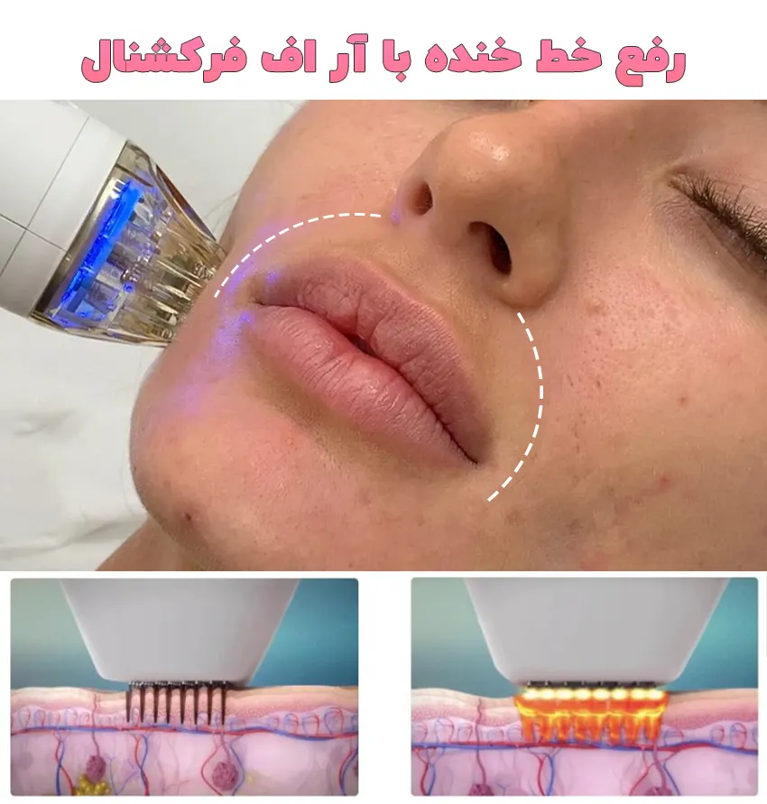 آر اف فرکشنال خط خنده