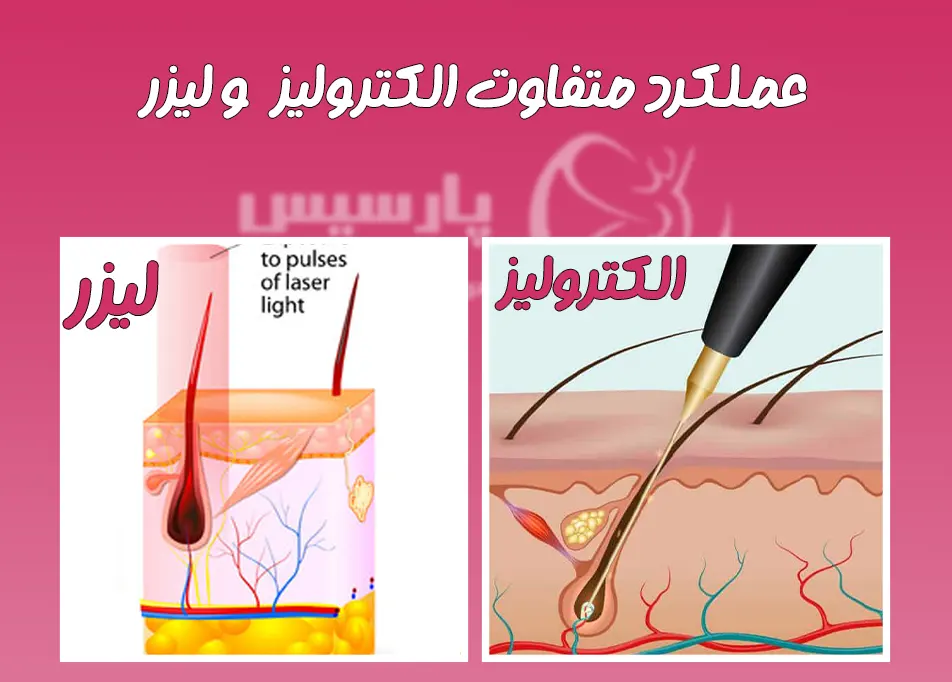 تفاوت الکترولیز موهای زائد و لیزر