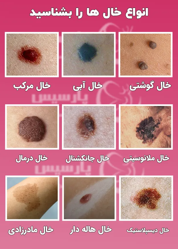 از کجا بفهمیم خال سرطانی است؟