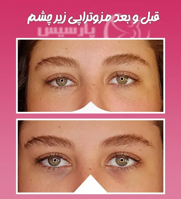 مزوتراپی زیر چشم