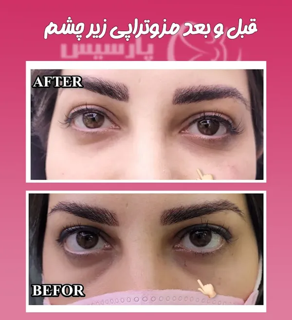 مزوتراپی زیر چشم