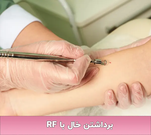 برداشتن خال با RF