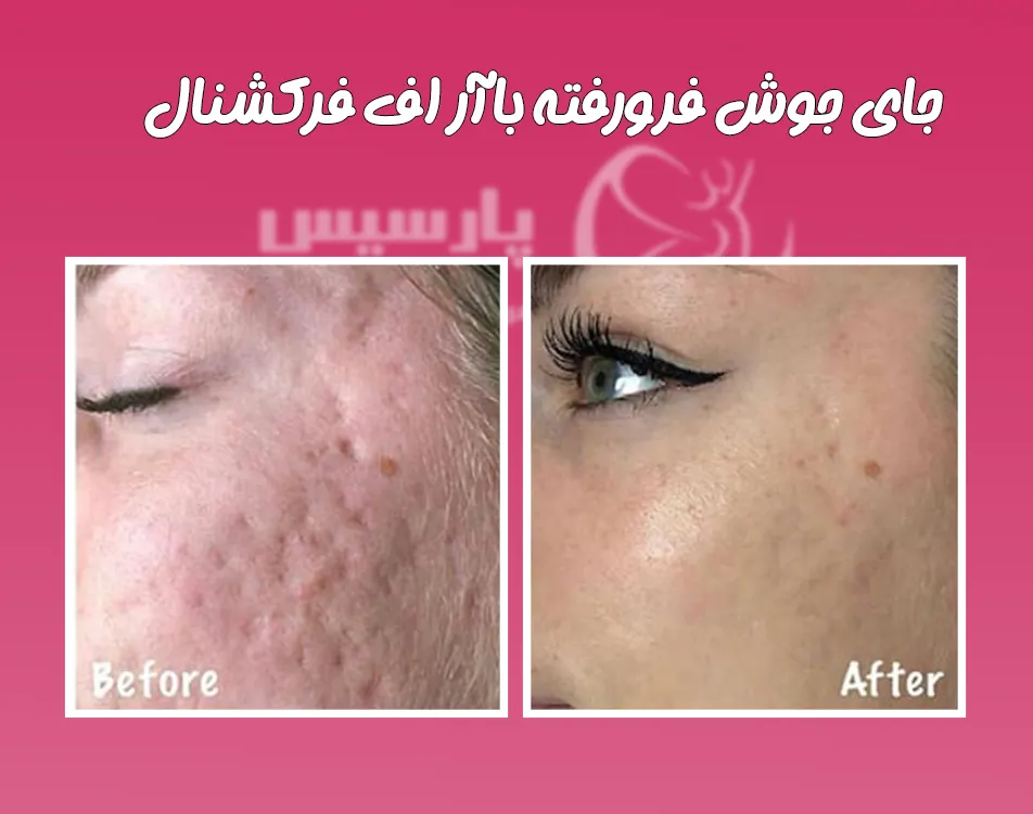 جای جوش فرورفته با آر اف فرکشنال