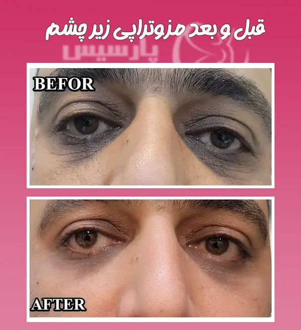 مزوتراپی زیر چشم