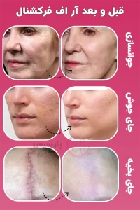 قبل و بعد آر اف فرکشنال صورت