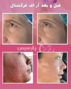 قبل و بعد آر اف فرکشنال صورت