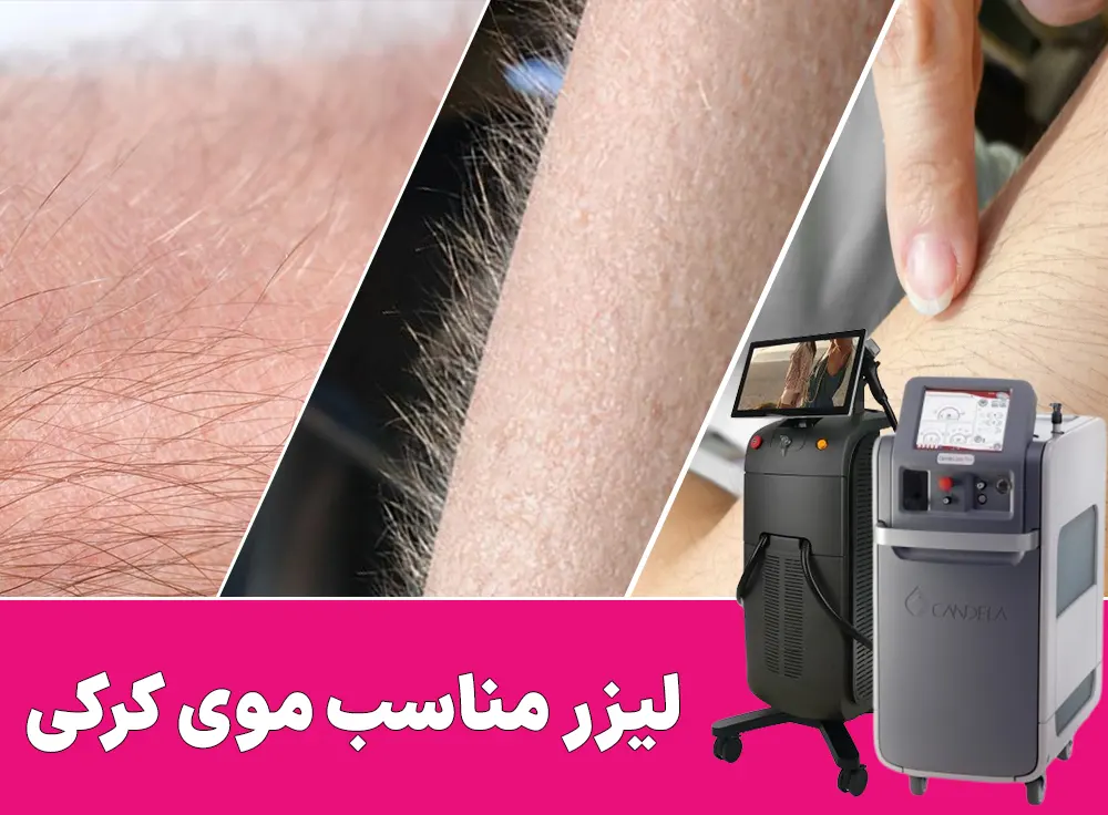 لیزر مناسب موهای کرکی
