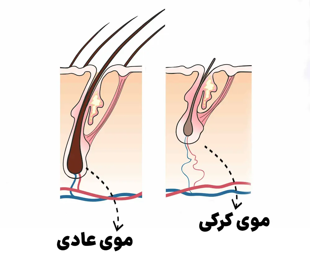 موی کرکی