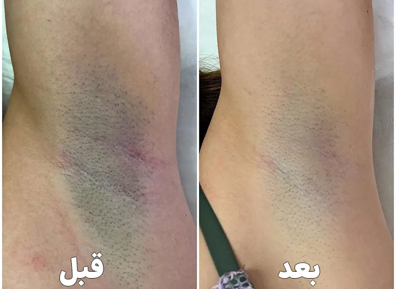 روشن شدن پوست با لیزر مو