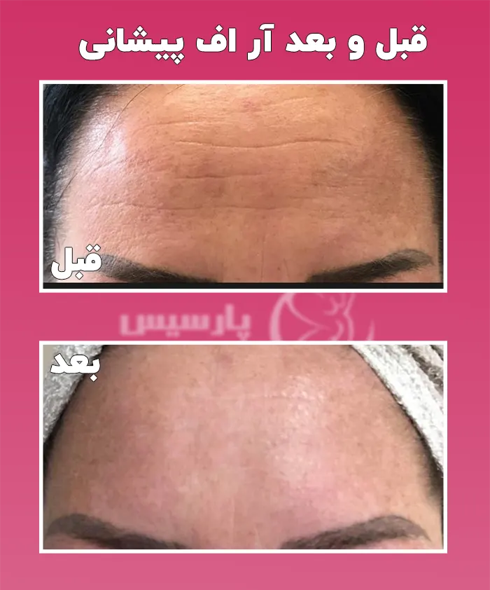 رفع چین و چروک پیشانی با آر اف
