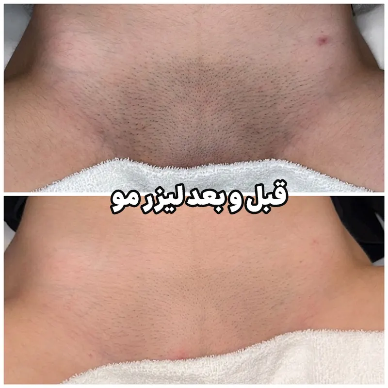 قبل و بعد لیزر مو