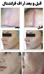 قبل بعد آر اف فرکشنال