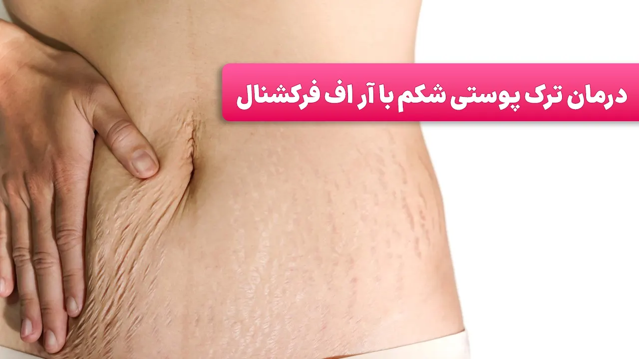 درمان ترک پوستی شکم با آر اف فرکشنال