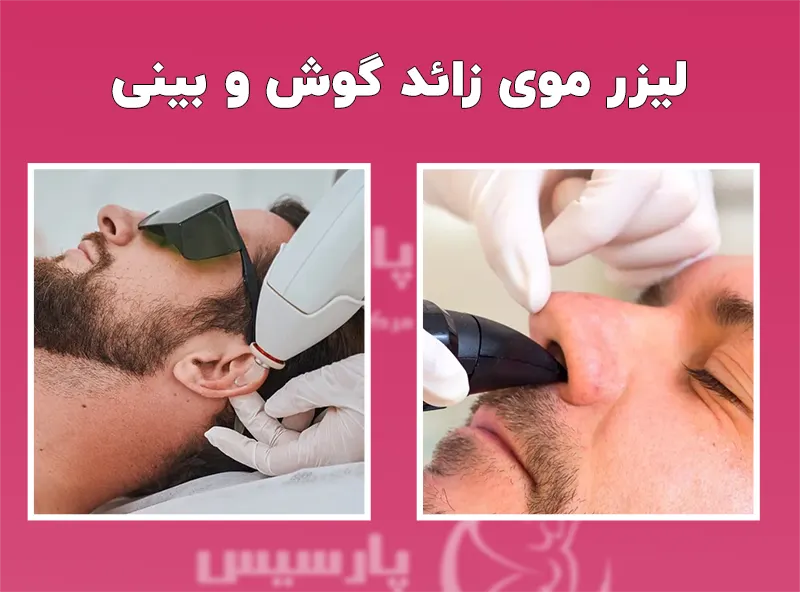 لیزر موهای زائد گوش و بینی
