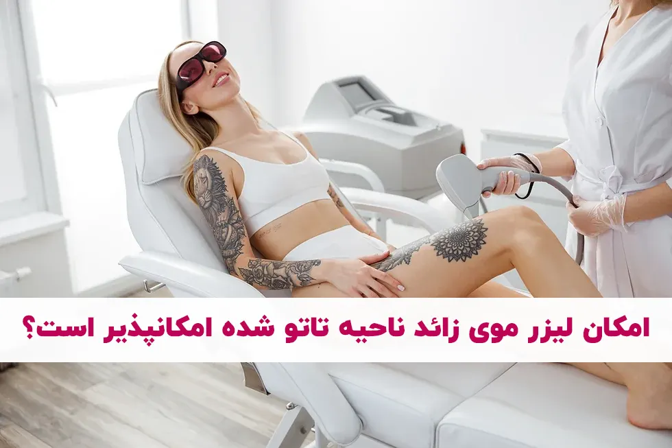 لیزر موی زائد ناحیه تاتو شده