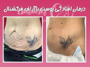 درمان افتادگی پوست با آر اف فرکشنال