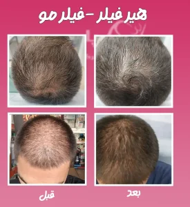 هیر فیلر