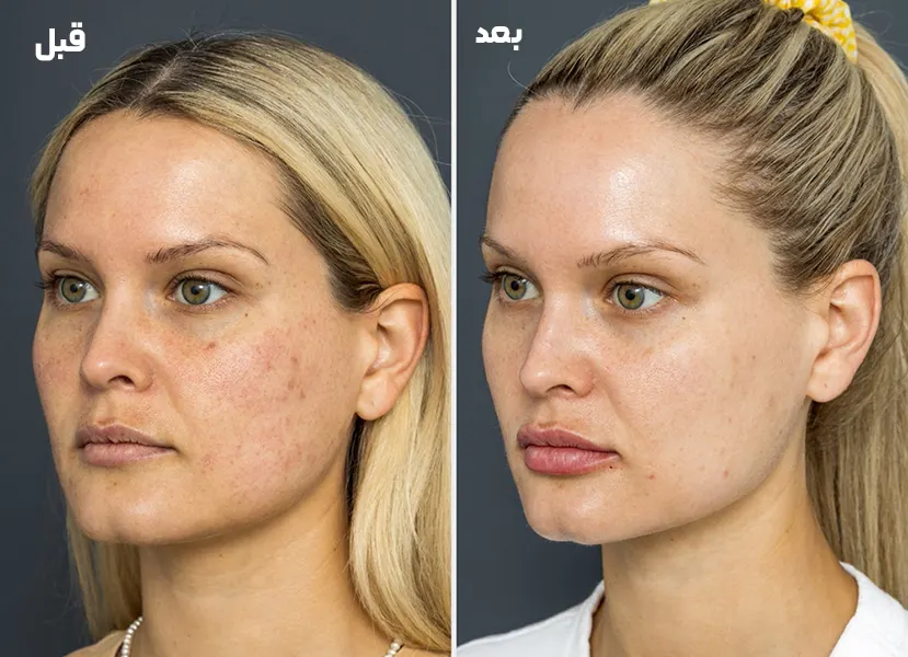 قبل و بعد میکرودرم ابریژن