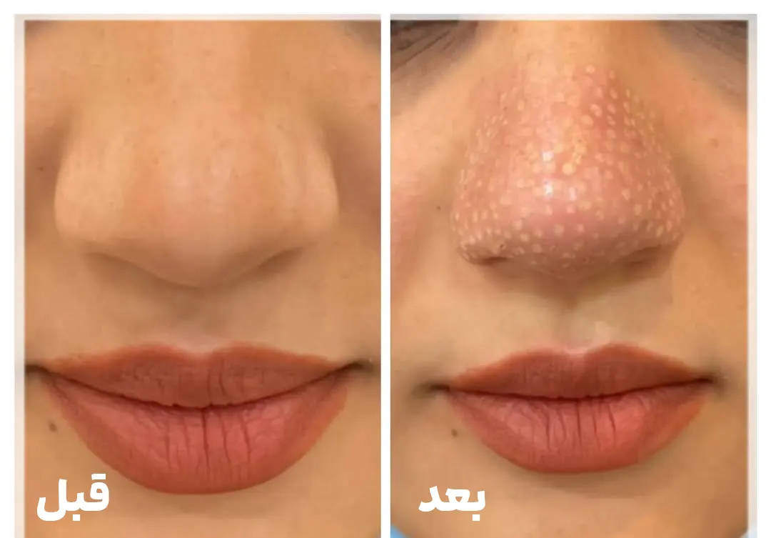 قبل و بعد پلاسما جت بینی گوشتی