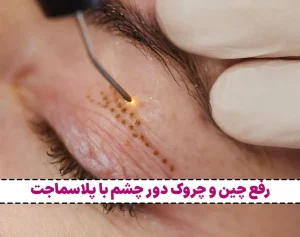 رفع چین و چروک دور چشم با پلاسماجت