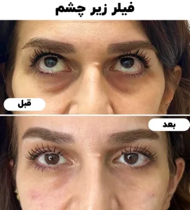 فیلر زیر چشم