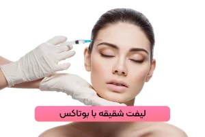 لیفت شقیقه با بوتاکس