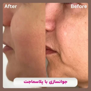 قبل و بعد جوانسازی با پلاسماجت